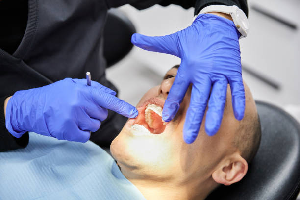 Best Emergency Dentist for Lost Fillings or Crowns in Westport, WA